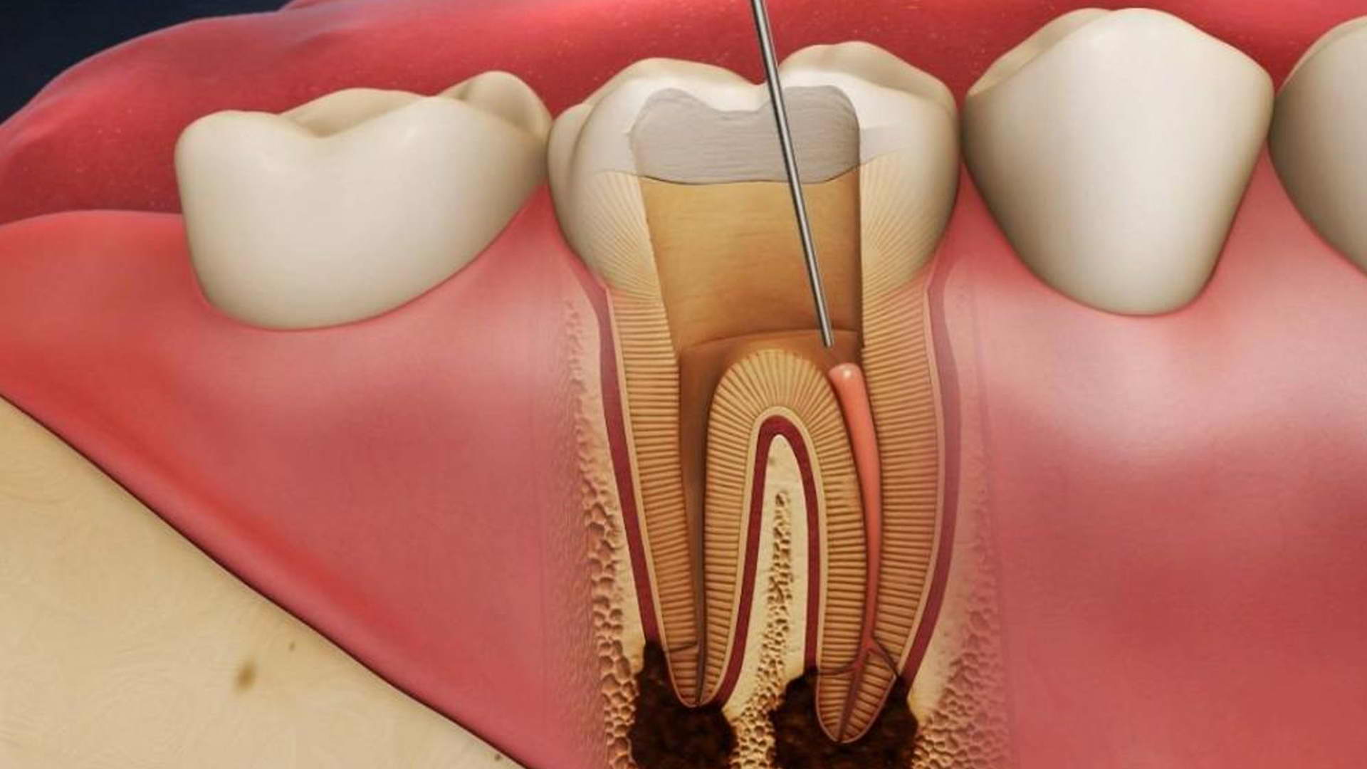 Не бойся лечить каналы зуба: все, что нужно знать