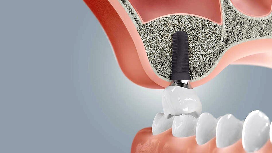 Синус-лифтинг в стоматологии: инновационная процедура для восстановления зубов