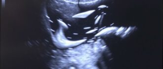 УЗИ щитовидной железы: понятный гид для тех, кто собирается на исследование