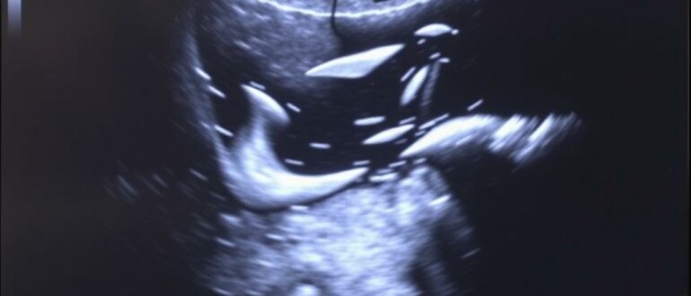 УЗИ щитовидной железы: понятный гид для тех, кто собирается на исследование