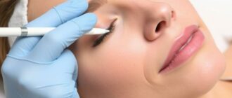 Мелазма: как убрать пятна и вернуть спокойствие коже