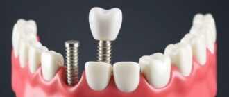 Имплантация зубов: что нужно знать прежде чем решиться